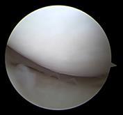 Stitch-normal-meniscus-copy-1 res